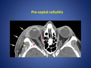 Pre-septal cellulitis
 