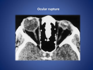 Ocular rupture
 