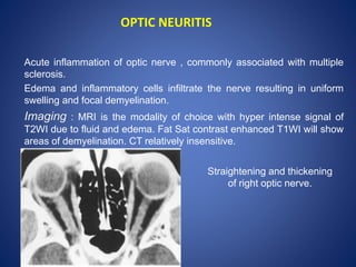 OPTIC NEURITIS
Acute inflammation of optic nerve , commonly associated with multiple
sclerosis.
Edema and inflammatory cells infiltrate the nerve resulting in uniform
swelling and focal demyelination.
Imaging : MRI is the modality of choice with hyper intense signal of
T2WI due to fluid and edema. Fat Sat contrast enhanced T1WI will show
areas of demyelination. CT relatively insensitive.
Straightening and thickening
of right optic nerve.
 