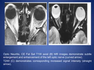 Optic Neuritis. CE Fat Sat T1W axial (B) MR images demonstrate subtle
enlargement and enhancement of the left optic nerve (curved arrow).
T2WI (C) demonstrates corresponding increased signal intensity (straight
arrow).
 