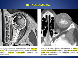 RETINOBLASTOMA
 