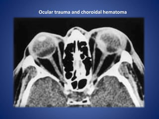 Ocular trauma and choroidal hematoma
 
