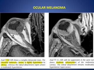 OCULAR MELANOMA
 