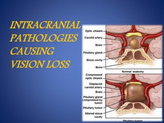 INTRACRANIAL
PATHOLOGIES
CAUSING
VISION LOSS
 