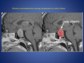 Pituitary macroadenoma causing compression on optic chiasm
 