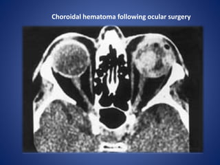 Choroidal hematoma following ocular surgery
 