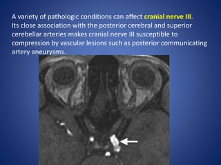 A variety of pathologic conditions can affect cranial nerve III.
Its close association with the posterior cerebral and superior
cerebellar arteries makes cranial nerve III susceptible to
compression by vascular lesions such as posterior communicating
artery aneurysms.
 