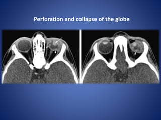 Perforation and collapse of the globe
 