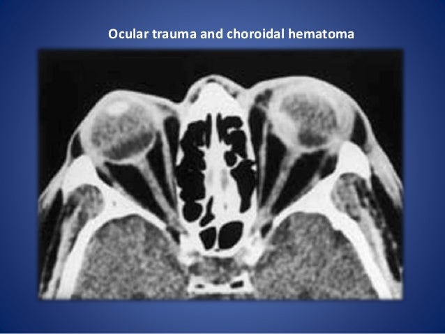Ocular Rupture 5 Trauma And Choroidal Hematoma Ocular Rupture 5 Trauma And Choroidal Hematoma