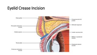 Eyelid Crease Incision
 