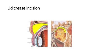 Lid crease incision
 