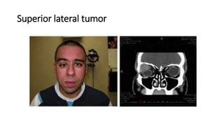 Superior lateral tumor
 