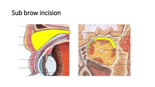 Sub brow incision
 