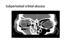 Subperiosteal orbital abscess
 