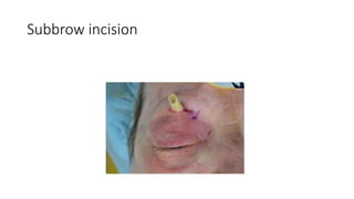 Subbrow incision
 