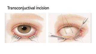 Transconjuctival incision
 