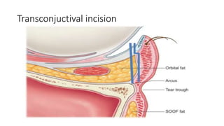 Transconjuctival incision
 