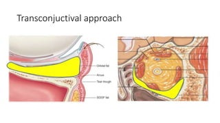 Transconjuctival approach
 