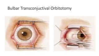 Bulbar Transconjuctival Orbitotomy
• .
 