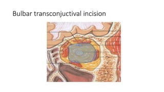 Bulbar transconjuctival incision
 