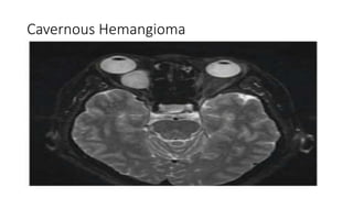Cavernous Hemangioma
 