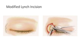 Modified Lynch Incision
 