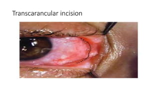 Transcarancular incision
 