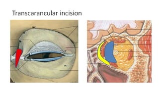 Transcarancular incision
 