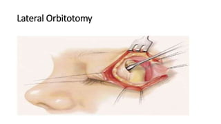 Lateral Orbitotomy
 