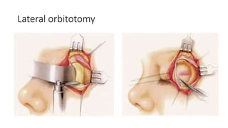 Lateral orbitotomy
 