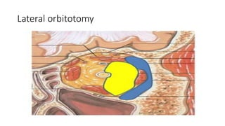 Lateral orbitotomy
 