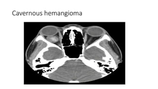 Cavernous hemangioma
 