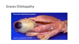 Graves Orbitopathy
 