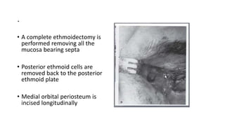 .
• A complete ethmoidectomy is
performed removing all the
mucosa bearing septa
• Posterior ethmoid cells are
removed back to the posterior
ethmoid plate
• Medial orbital periosteum is
incised longitudinally
• .
 