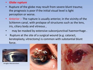 Orbital trauma | PPTX
