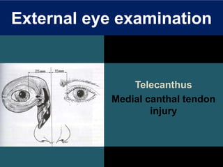 External eye examination
Telecanthus
Medial canthal tendon
injury
 