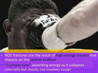 • NOE fractures are the result of high-energy trauma that
impacts on the central midface
• “Crumple zone” absorbing energy as it collapses
internally but mostly not involves ocular
 