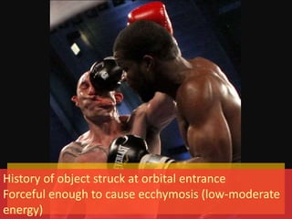 History of object struck at orbital entrance
Forceful enough to cause ecchymosis (low-moderate
energy)
 