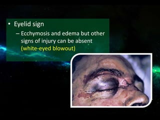 • Eyelid sign
– Ecchymosis and edema but other
signs of injury can be absent
(white-eyed blowout)
 