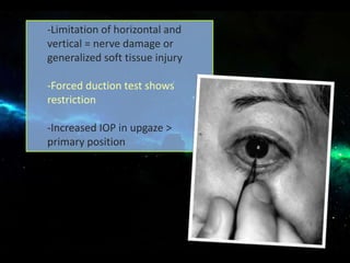 -Limitation of horizontal and
vertical = nerve damage or
generalized soft tissue injury
-Forced duction test shows
restriction
-Increased IOP in upgaze >
primary position
 