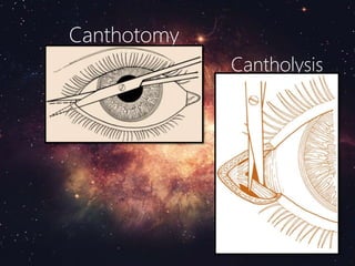 Canthotomy
Cantholysis
 