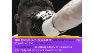 • NOE fractures are the result of high-energy trauma that
impacts on the central midface
• “Crumple zone” absorbing energy as it collapses
internally but mostly not involves ocular
 