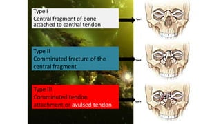 Type I
Central fragment of bone
attached to canthal tendon
Type II
Comminuted fracture of the
central fragment
Type III
Comminuted tendon
attachment or avulsed tendon
 