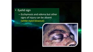 • Eyelid sign
– Ecchymosis and edema but other
signs of injury can be absent
(white-eyed blowout)
 