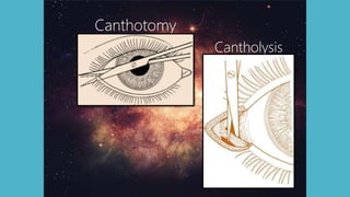 Canthotomy
Cantholysis
 