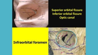 Superior orbital fissure
Inferior orbital fissure
Optic canal
Infraorbital foramen
 