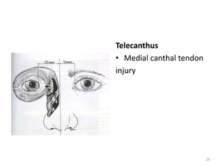 Telecanthus
• Medial canthal tendon
injury
28
 