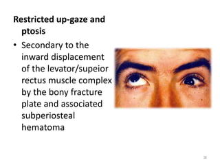 Restricted up-gaze and
ptosis
• Secondary to the
inward displacement
of the levator/supeior
rectus muscle complex
by the bony fracture
plate and associated
subperiosteal
hematoma
36
 