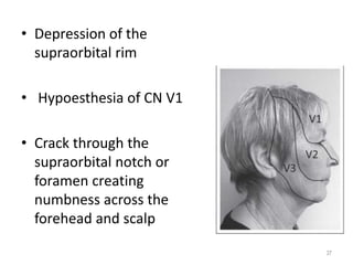 • Depression of the
supraorbital rim
• Hypoesthesia of CN V1
• Crack through the
supraorbital notch or
foramen creating
numbness across the
forehead and scalp
37
 