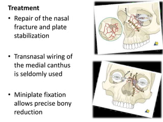 Treatment
• Repair of the nasal
fracture and plate
stabilization
• Transnasal wiring of
the medial canthus
is seldomly used
• Miniplate fixation
allows precise bony
reduction 43
 